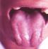 Diagnóstico por el color de la lengua